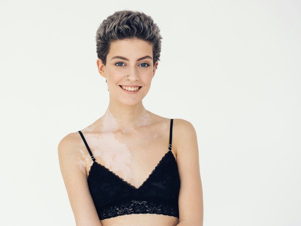 Lentigo : astuces pour atténuer les taches cutanées